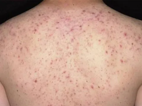 Viêm Nang Lông: Nguyên Nhân, Triệu Chứng & Cách Điều Trị Hiệu Quả