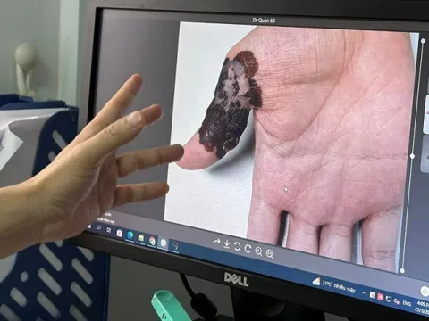 Hà Nội: Nam thanh niên phát hiện ung thư da nhờ nốt ruồi trên lòng bàn tay