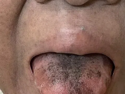 Người phụ nữ mọc lông ở lưỡi vì tác dụng phụ của thuốc kháng sinh