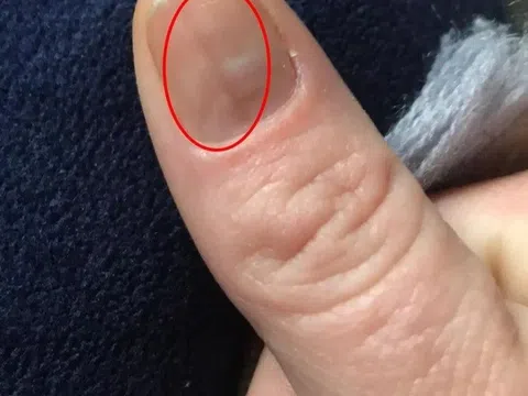 Người phụ nữ phát hiện bị ung thư nhờ vết bầm trên móng tay