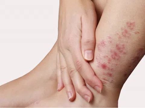 Bảo Thanh Đường - Địa chỉ uy tín chữa tận gốc bệnh chàm - eczema