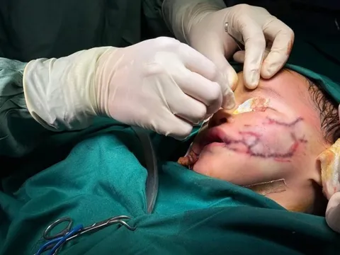 Bé 2 tuổi bị chó nhà nuôi cắn xé khắp mặt