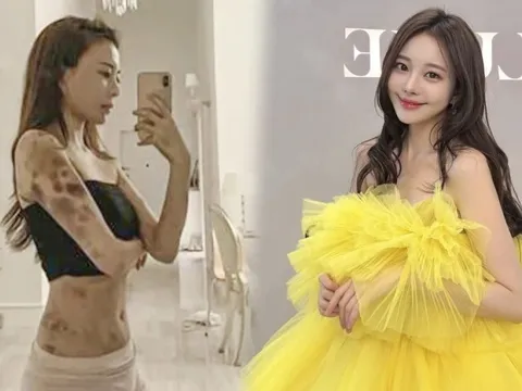 Hot girl Hàn bàng hoàng khi cả cơ thể bầm tím sau 2 giờ gây mê làm đẹp