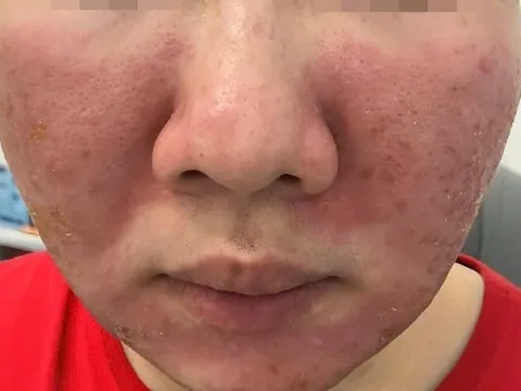 Mặt bỏng, da sạm vì tin kem 'siêu chống nắng' giá 95.000 đồng trên mạng
