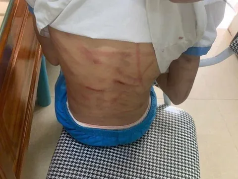 Xác minh thông tin bé gái nghi bị cha dượng bạo hành