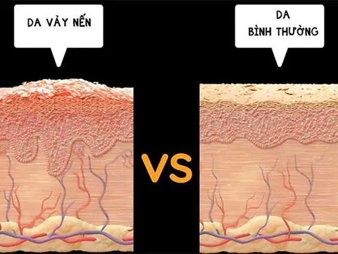 Bệnh vảy nên và cách điều trị hiệu quả triệt để tại Bảo Thanh Đường