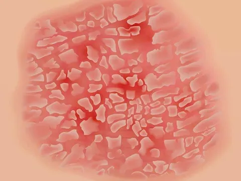 Vảy nến tái phát - Cách điều trị từ lời khuyên các chuyên gia Bảo Thanh Đường