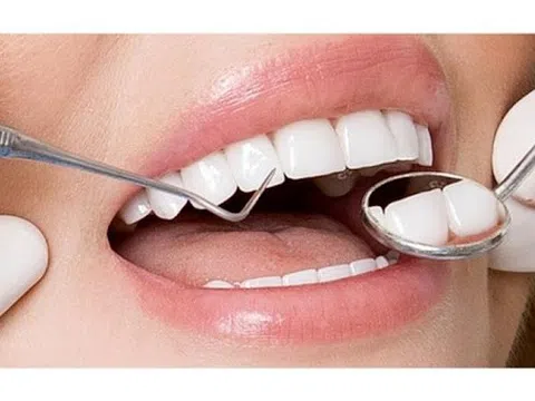 Bọc răng sứ và những điều có thể bạn chưa biết 