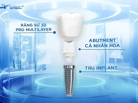 Trụ Implant có phải bộ phận quan trọng nhất? Lý giải 4 lầm tưởng thường gặp