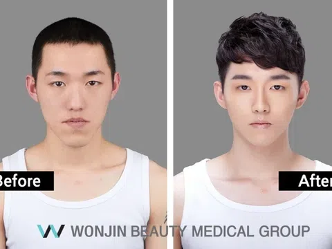 2 idol Kpop được coi là hình mẫu phẫu thuật thẩm mỹ của nam giới