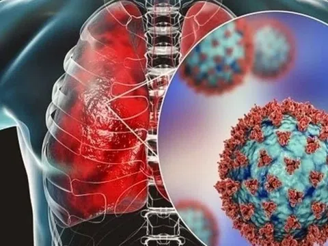 Virus viêm phổi HMPV đang lây lan ở Trung Quốc nguy hiểm ra sao?