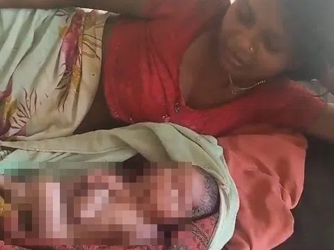 Em bé sinh ra có 2 khuôn mặt và 8 tay chân gây chấn động