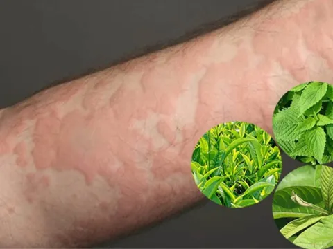 Mẹo dân gian trị ngứa da: Hiệu quả đến đâu?