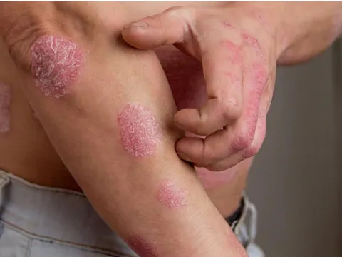 Bổ huyết - Dưỡng âm: Nguyên tắc trong điều trị bệnh viêm da lâu ngày