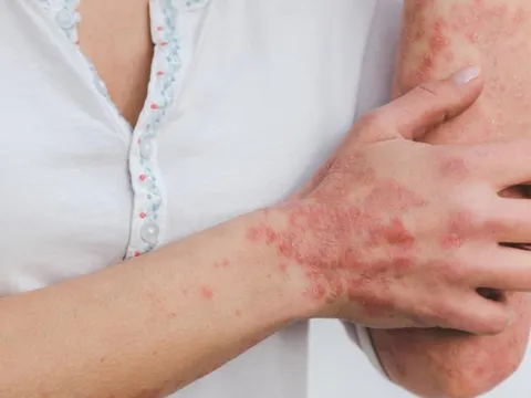 Điều trị sớm bệnh vẩy nến tránh nguy cơ biến chứng