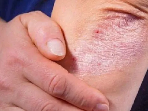 Có nên tự dùng thuốc để chữa bệnh vảy nến?