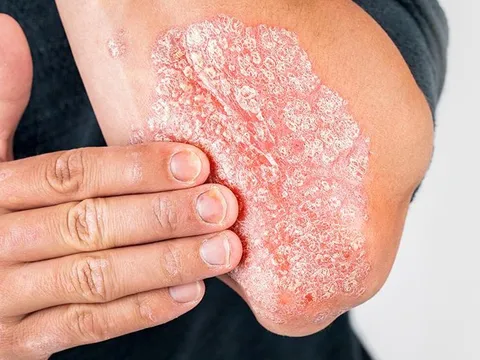 Bệnh vảy nến có lây không?