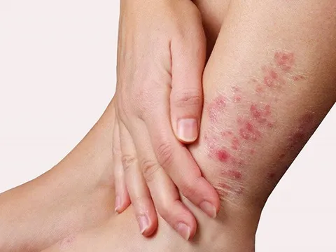 Bảo Thanh Đường - Địa chỉ uy tín chữa tận gốc bệnh chàm (eczema)