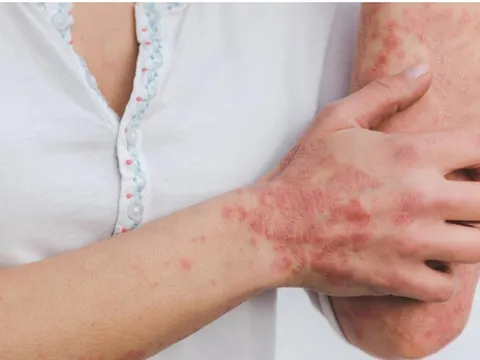 Điều trị sớm bệnh vẩy nến tránh nguy cơ biến chứng