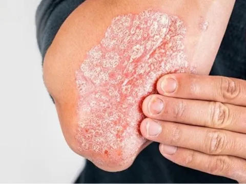 Vảy nến tái phát phải làm sao? Lắng nghe tư vấn từ chuyên gia