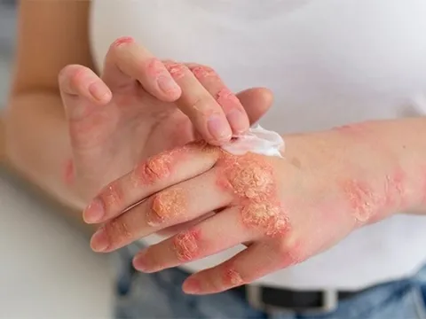 Đi tìm nơi chữa bệnh chàm