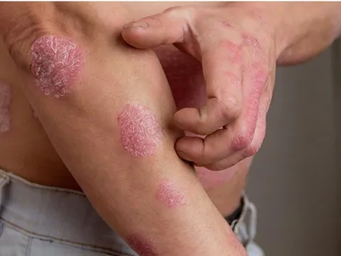 Bổ huyết - Dưỡng âm: Nguyên tắc trong điều trị bệnh viêm da lâu ngày