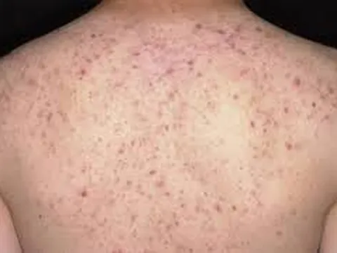 Bệnh viêm nang lông và cách điều trị
