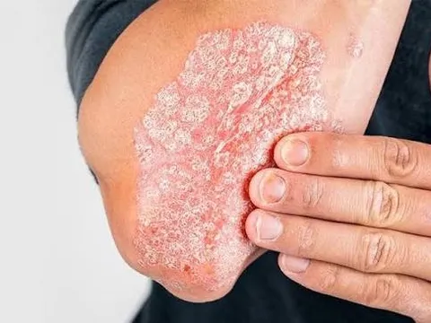 CÁCH CHỮA BỆNH VẢY NẾN LÂU NĂM