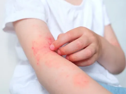 Điều Trị Viêm Da Cơ Địa Bằng Thuốc Nam: Hướng Đi Lành Tính, Hiệu Quả Và Bền Vững