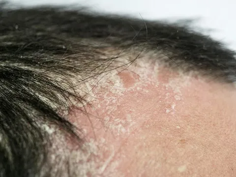 Vảy Nến Có Khó Chữa Không? Góc Nhìn Từ Y Học Cổ Truyền