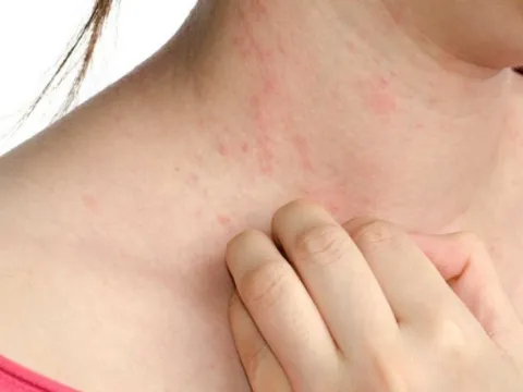 Dị Ứng Thời Tiết Nổi Mẩn Khắp Người Phải Làm Sao?