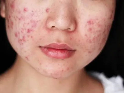 Tại sao đã qua dậy thì vẫn nhiều mụn trứng cá?