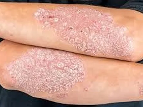 Bệnh Vảy Nến: Phân Tích Toàn Diện Về Mức Độ Nguy Hiểm Và Các Giải Pháp Điều Trị Hiện Đại