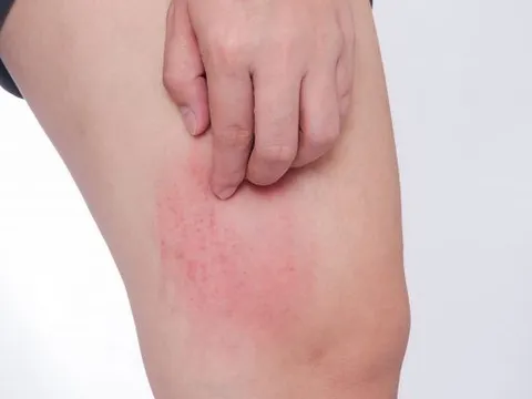 Mẹo dân gian trị ngứa da: Hiệu quả đến đâu?