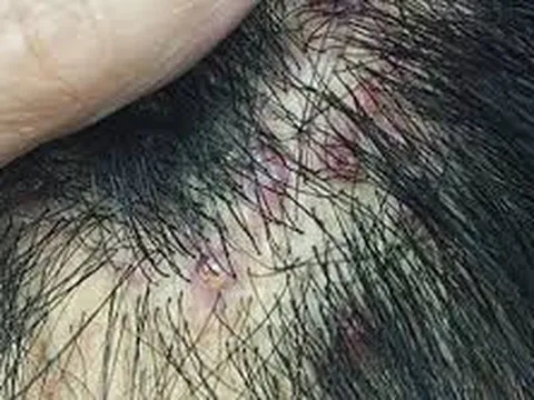 Bảo Thanh Đường - Điều trị dứt điểm bệnh viêm chân tóc