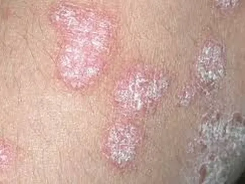 Điều trị sớm bệnh vẩy nến tránh nguy cơ biến chứng