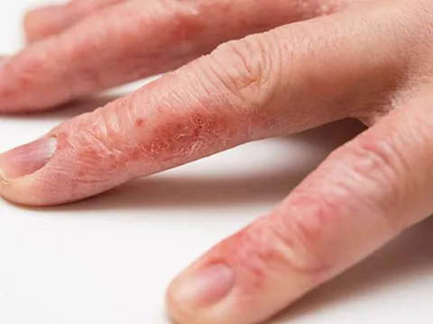 Chữa bệnh chàm á sừng bằng phương thuốc quý tại Bảo Thanh Đường