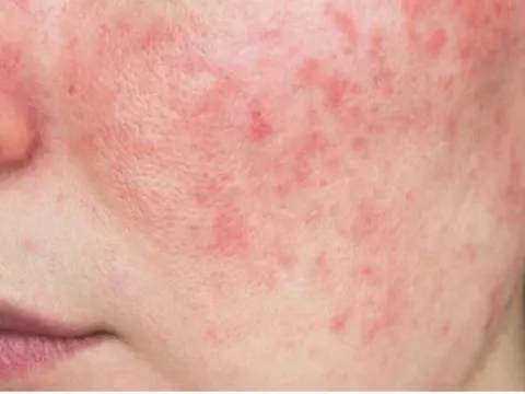 Cách nhận biết da bị nhiễm corticoid và hướng xử lý bằng thảo dược