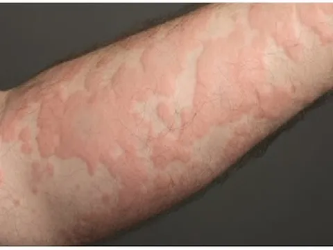 “Tôi đã từng nghĩ mình phải sống chung với bệnh mề đay suốt đời…”