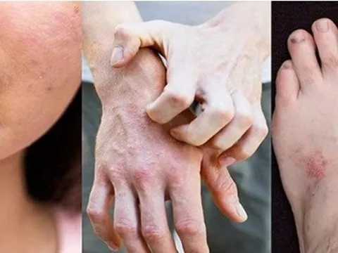 Phương thuốc nổi tiếng trị bệnh ngoài da - Bảo Thanh Đường