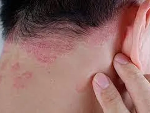 Tôi đã chữa khỏi bệnh vảy nến ở Bảo Thanh Đường