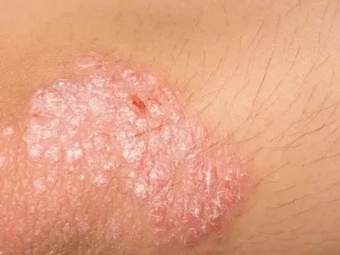 Cần làm gì khi mắc bệnh vảy nến?