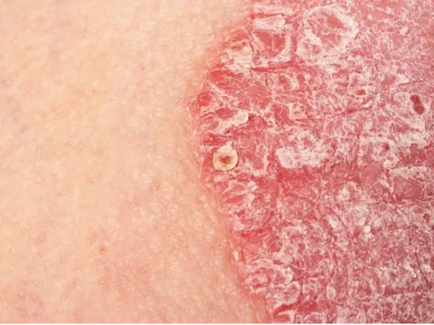 Các giai đoạn vảy nến thường gặp và hướng điều trị