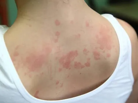 Bổ huyết - Dưỡng âm: Nguyên tắc trong điều trị bệnh viêm da lâu ngày