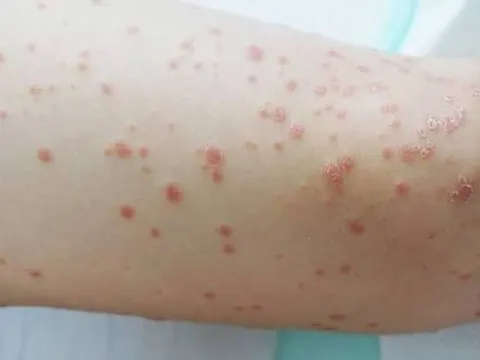 Chữa bệnh vảy nến thể giọt bằng thảo dược