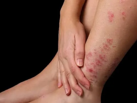 Bệnh vảy nến có lây không?