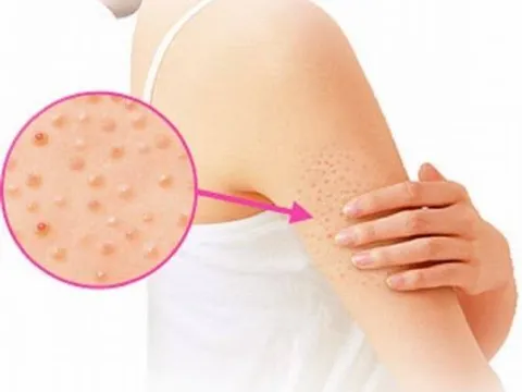 Bệnh viêm nang lông và cách điều trị