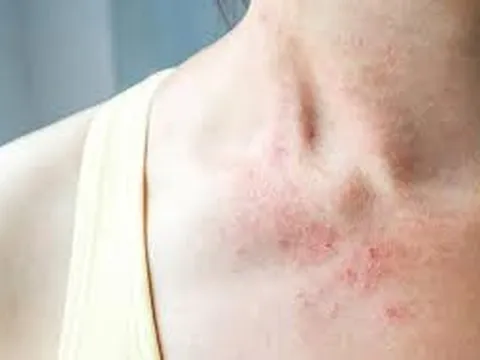 Dị Ứng Thời Tiết Nổi Mẩn Khắp Người Phải Làm Sao?