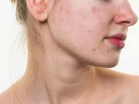 Tại sao đã qua dậy thì vẫn nhiều mụn trứng cá?