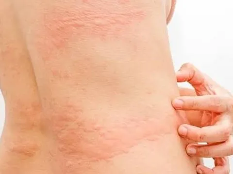 Nổi mề đay khi trời chuyển lạnh phải làm sao? Bật mí giải pháp hiệu quả từ YHCT